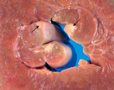 Figure 16-54, Insertion sites for chordae tendineae.