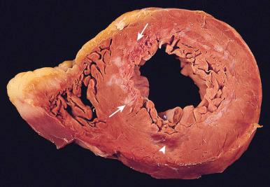 Figure 16-55, Acute and healed subendocardial myocardial infarcts.