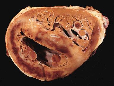 Figure 16-56, Large acute subendocardial myocardial infarct.