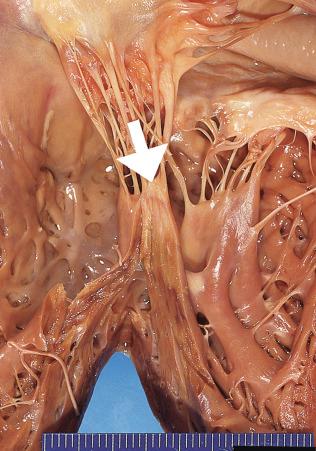 Figure 16-57, Subendocardial myocardial infarct in papillary muscle.