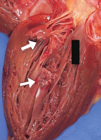 Figure 16-58, Papillary muscle rupture from acute myocardial infarction.