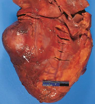 Figure 16-59, Ventricular aneurysm from myocardial infarction.