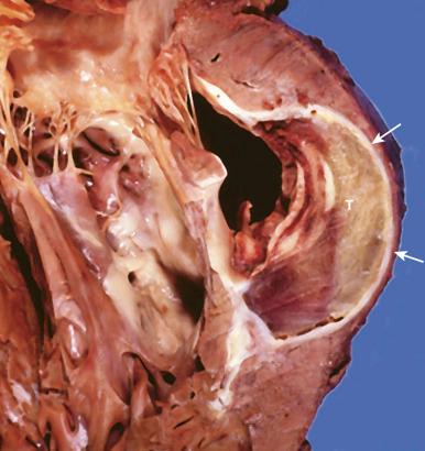 Figure 16-60, Ventricular aneurysm from myocardial infarction.