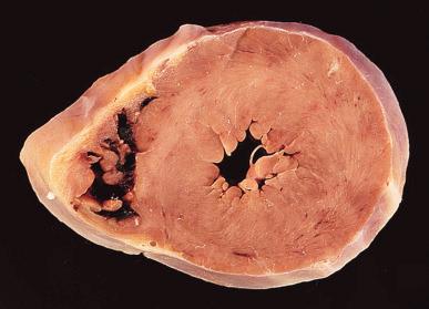 Figure 16-61, Myocarditis.