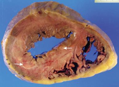 Figure 16-62, Giant cell myocarditis.