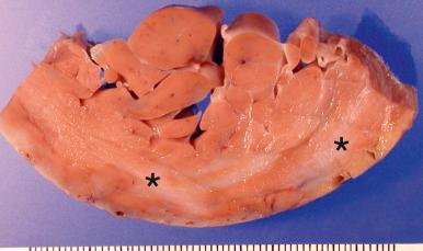 Figure 16-63, Sarcoid myocarditis.