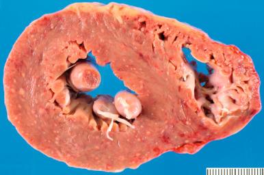 Figure 16-64, Disseminated infection, myocardial.