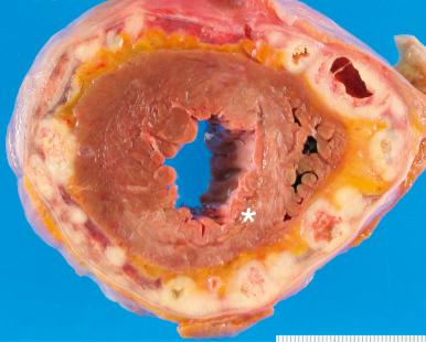 Figure 16-65, Pericardial metastasis.