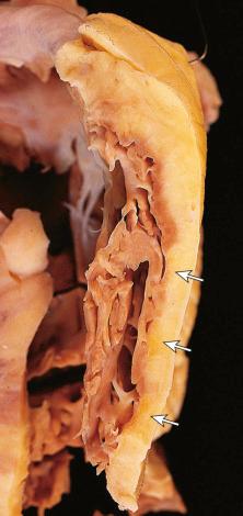 Figure 16-67, Arrhythmogenic right ventricular cardiomyopathy.