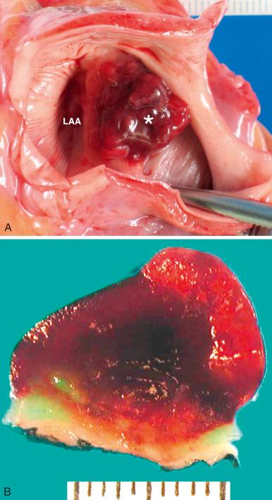 Figure 16-68, Atrial myxoma.