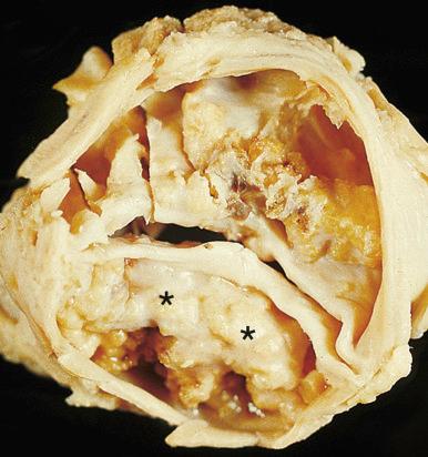 Figure 16-69, Bicuspid aortic valve.