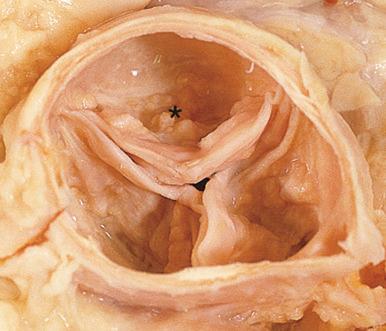 Figure 16-70, Aortic stenosis.