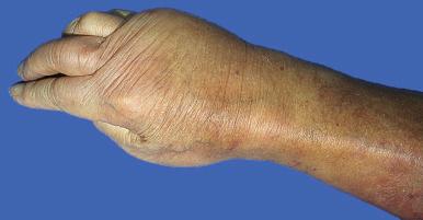 Figure 16-7, Edema.