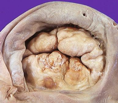 Figure 16-71, Mitral stenosis.