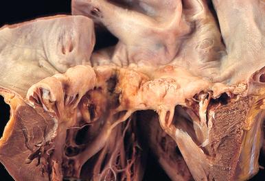 Figure 16-72, Mitral stenosis.