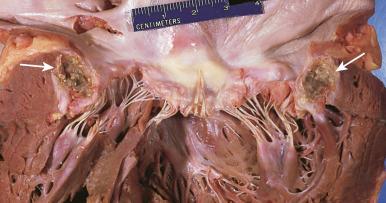 Figure 16-73, Mitral annular calcification.