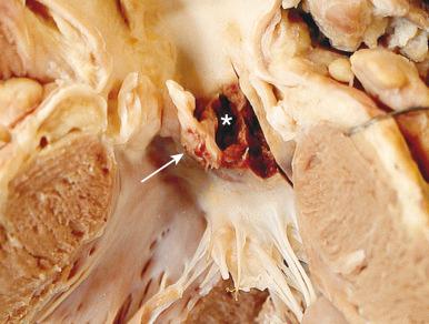 Figure 16-74, Ring (annular) abscess.