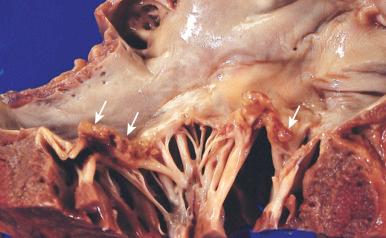 Figure 16-75, Infective endocarditis of a deformed mitral valve.