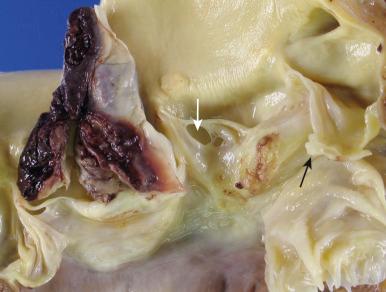 Figure 16-76, Infective endocarditis of aortic valve.