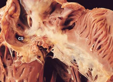 Figure 16-77, Infective endocarditis of tricuspid valve.