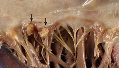 Figure 16-78, Nonbacterial thrombotic endocarditis. Nonbacterial thrombotic endocarditis primarily affects debilitated patients, hence its old categorization as “marantic.” Resembling the lesions of infective endocarditis, these nodules are composed of sterile thrombi. This mitral valve shows a linear array of tiny vegetations (arrows) along the edges of the leaflets, with no evidence of leaflet destruction.