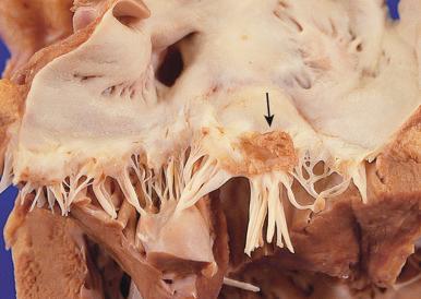 Figure 16-79, Large nonbacterial thrombotic endocarditis.