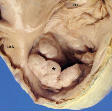 Figure 16-81, Mitral valve prolapse, severe.
