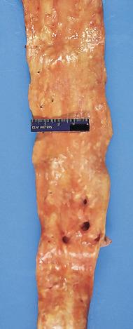 Figure 16-83, Fatty streaks, aorta.