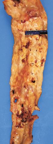 Figure 16-84, Severe atherosclerosis, aorta.