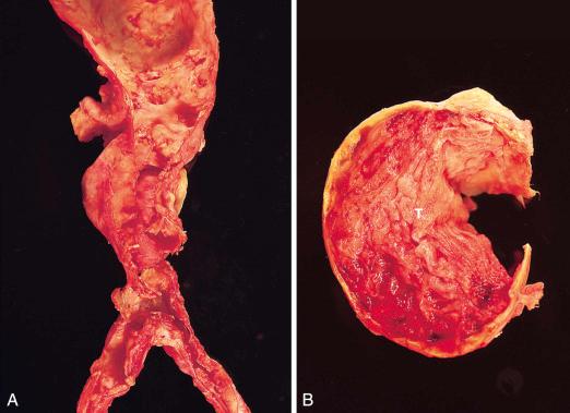 Figure 16-85, Aortic aneurysm.