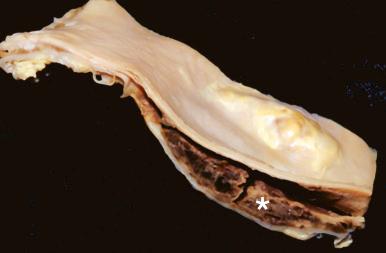 Figure 16-86, Dissecting hematoma of aorta.