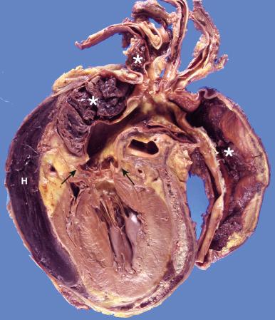 Figure 16-87, Type A aortic dissection.