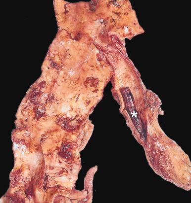 Figure 16-88, Thromboembolism to the superior mesenteric artery.