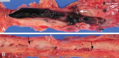 Figure 16-89, Deep venous thrombus.