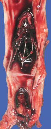 Figure 16-90, Vena cava filter.