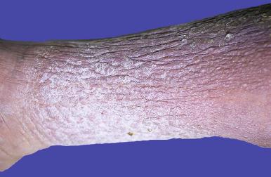 Figure 16-9, Lymphedema.