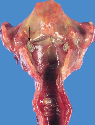 Figure 16-91, Iatrogenic laryngeal ulcers.