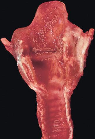 Figure 16-92, Upper respiratory tract bacterial infection.