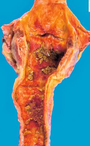 Figure 16-93, Upper respiratory tract fungal infection.