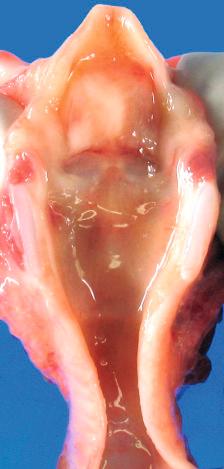 Figure 16-94, Laryngeal edema.