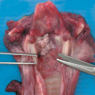 Figure 16-95, Upper respiratory tract papillomatosis.