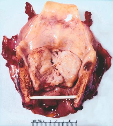 Figure 16-96, Squamous cell carcinoma of the larynx.