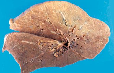 Figure 16-97, Dorsal lividity in lung.