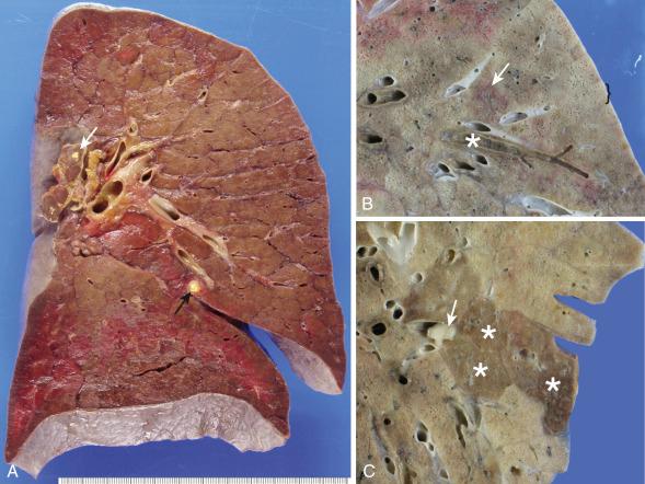 Figure 16-98, Diffuse alveolar damage (adult respiratory distress syndrome).