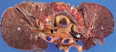 Figure 16-100, Large pulmonary thromboembolus.