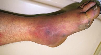 Figure 16-10, Cellulitis.