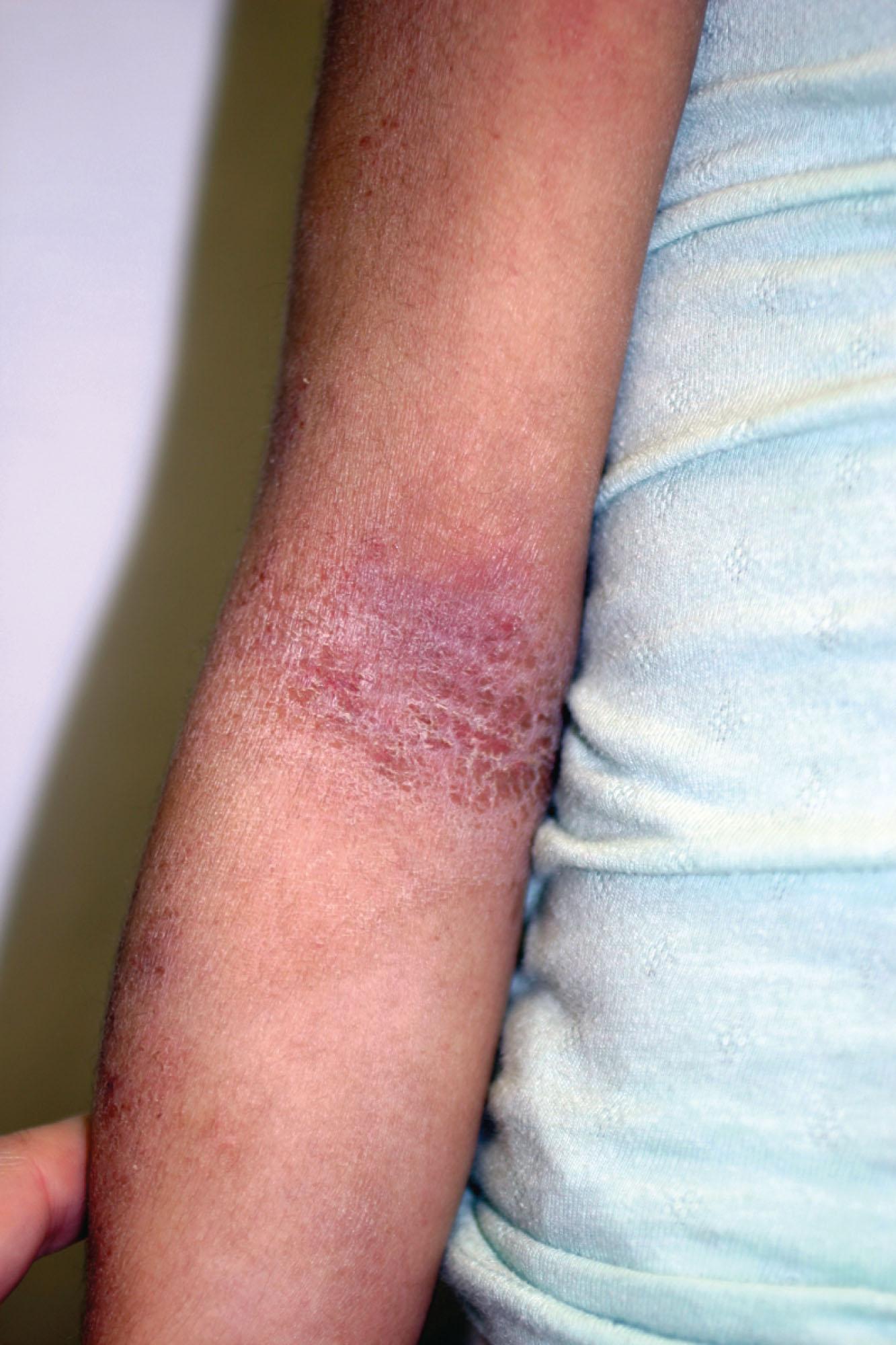 Figure 190.1, Atopic dermatitis (arm).