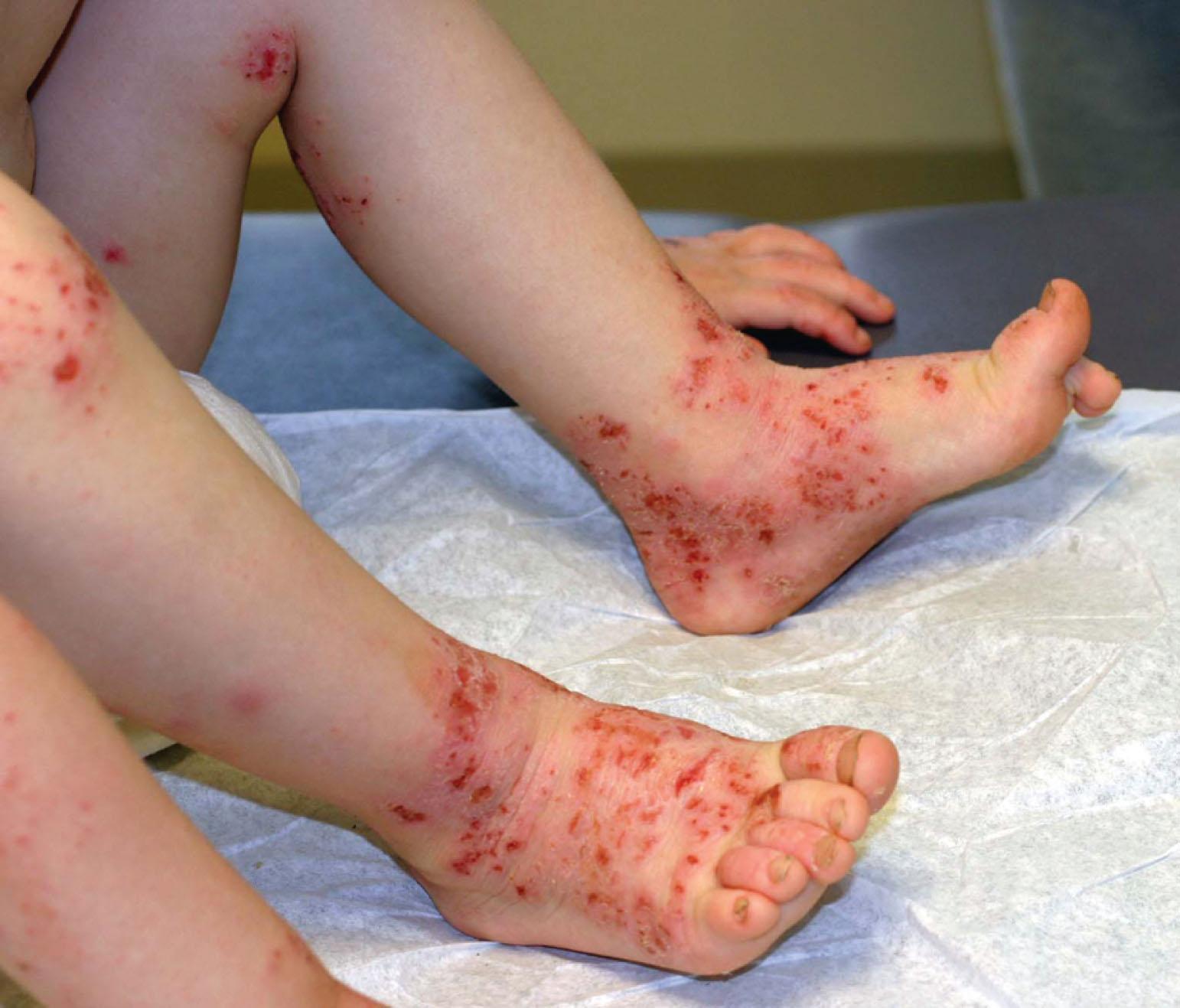 Figure 190.2, Atopic dermatitis with Staphylococcus superinfection.