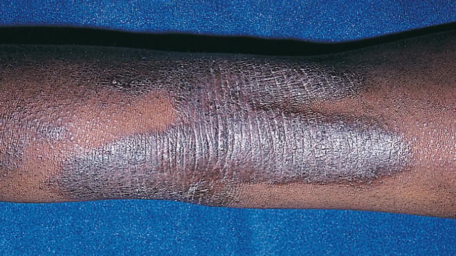Fig. 170.3, Lichenification of the popliteal fossa from chronic rubbing of the skin in atopic dermatitis.