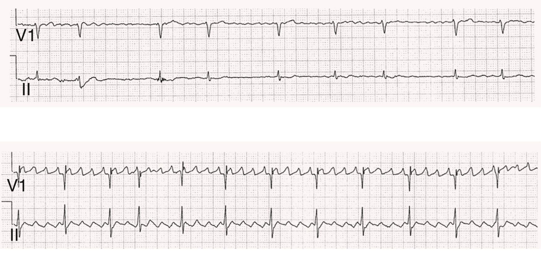 FIGURE 66.1, Comparison between the f waves of AF (top panel) and the flutter waves of atrial flutter (bottom panel). Note that f waves are variable in rate, shape, and amplitude, whereas flutter waves are constant in rate and morphology. Shown are leads V 1 and II.